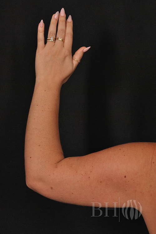 Arm Lift Before & After